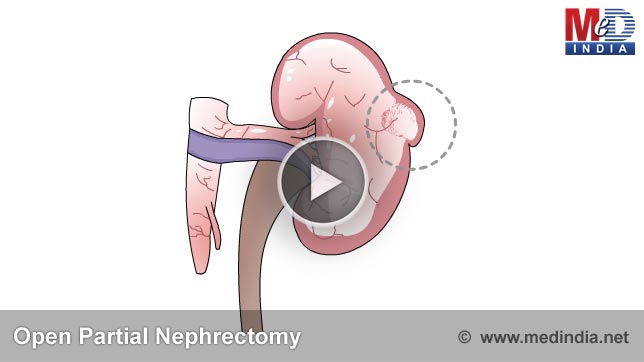 Open Partial Nephrectomy Steps