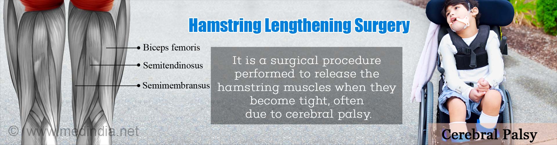 Hamstring Lengthening Surgery