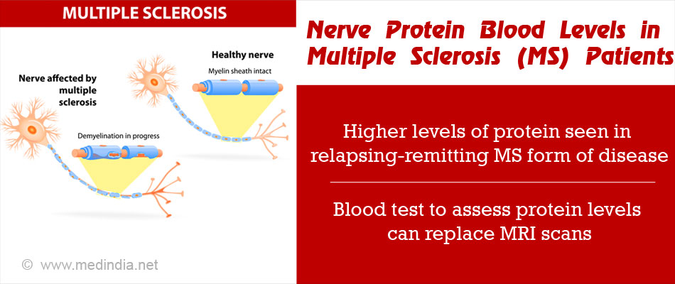 Multiple sclerosis test online