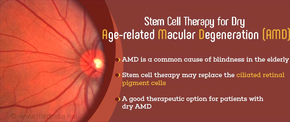 Stem Cells are a Potential Therapy for Agerelated Macular