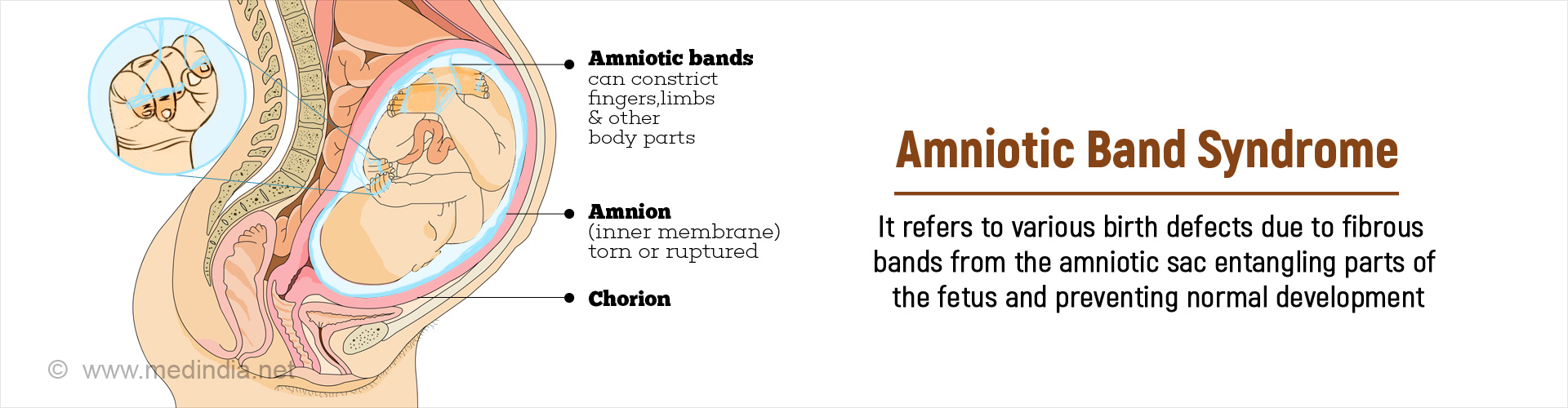 Amniotic Band Syndrome Causes Risk Factors Symptoms Diagnosis