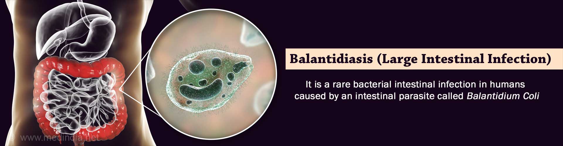 Balantidiasis Large Intestinal Infection Causes Symptoms Signs