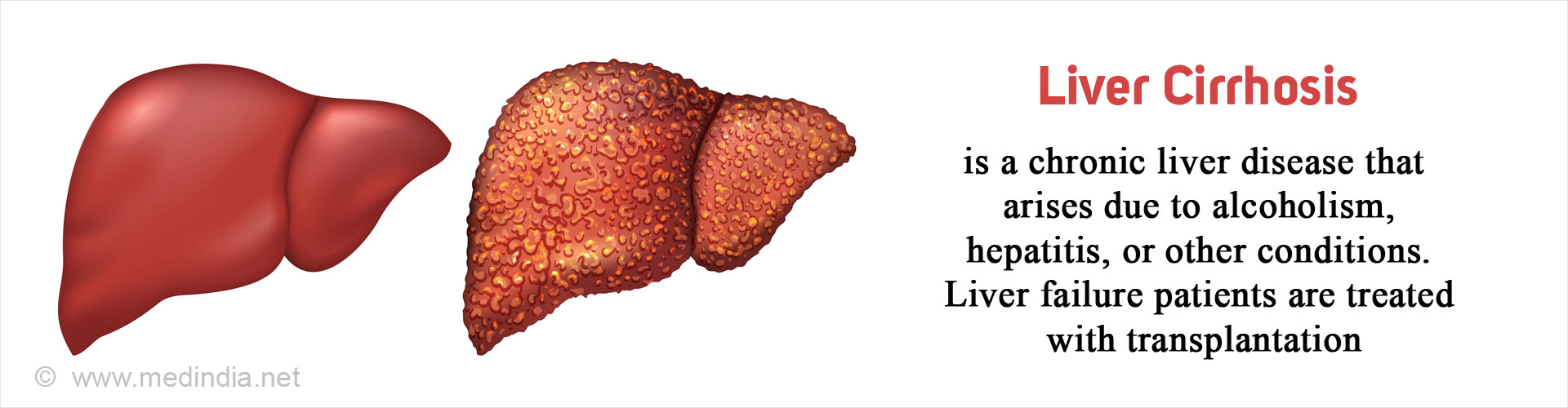 Liver Cirrhosis Causes Symptoms Diagnosis Treatment And Prevention