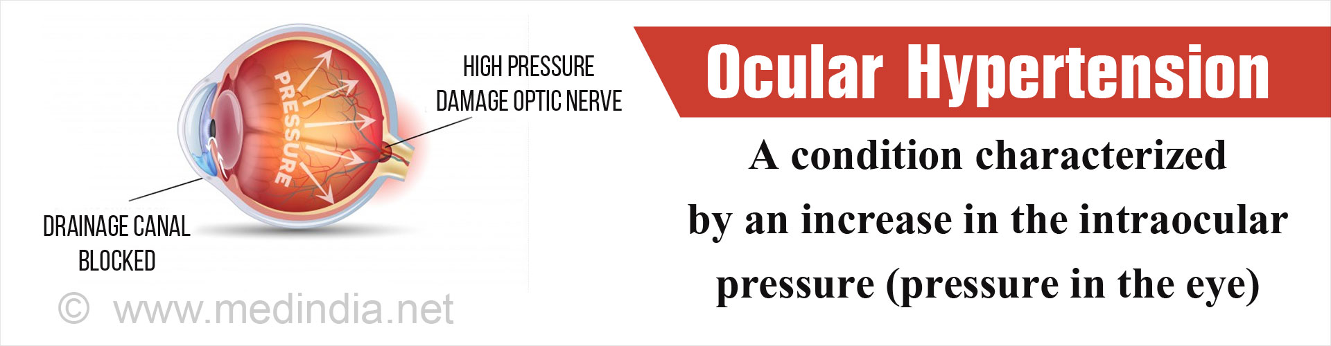 ocular-hypertension-causes-symptoms-diagnosis-treatment-prevention