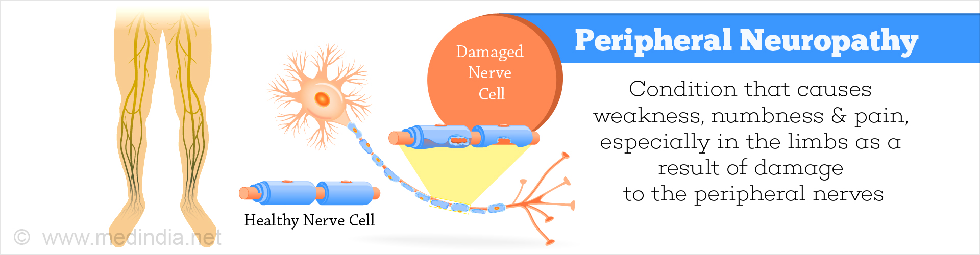 Peripheral Neuropathy - Types, Causes, Symptoms, Diagnosis, Treatment ...