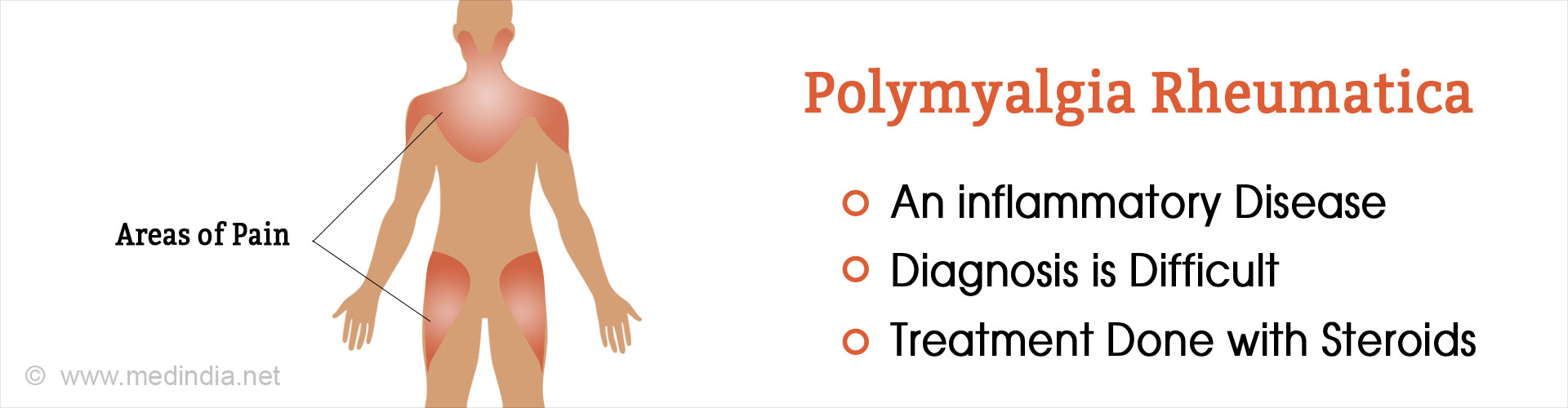 Polymyalgia Rheumatica Causes Symptoms Diagnosis Treatment And Prevention