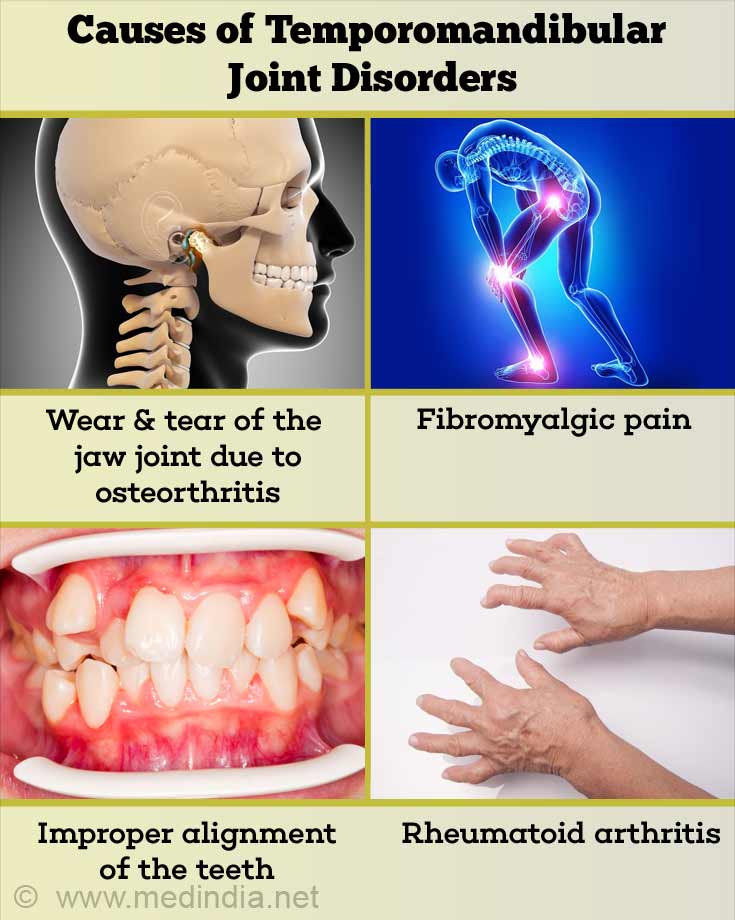 Temporomandibular Joint Disorders   Causes, Symptoms, Diagnosis & Treatment