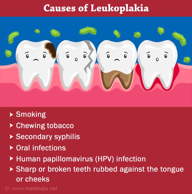 Leukoplakia An Overview Of Causes Symptoms And Treatment