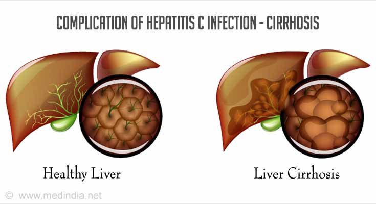 Hepatitis C - Causes, Symptoms, Diagnosis, Treatment, Complications ...