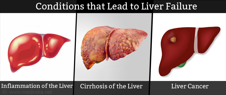 Liver Transplantation Facts, Contraindications