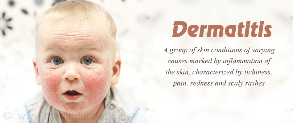 Dermatitis Causes Types Clinical Features Diagnosis Treatment And Prevention 0095