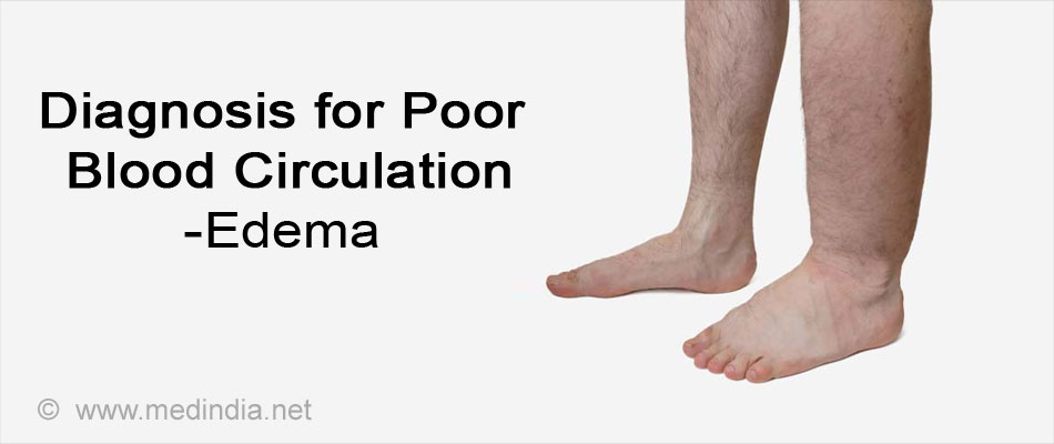 poor-blood-circulation-causes-symptoms-diagnosis-treatment