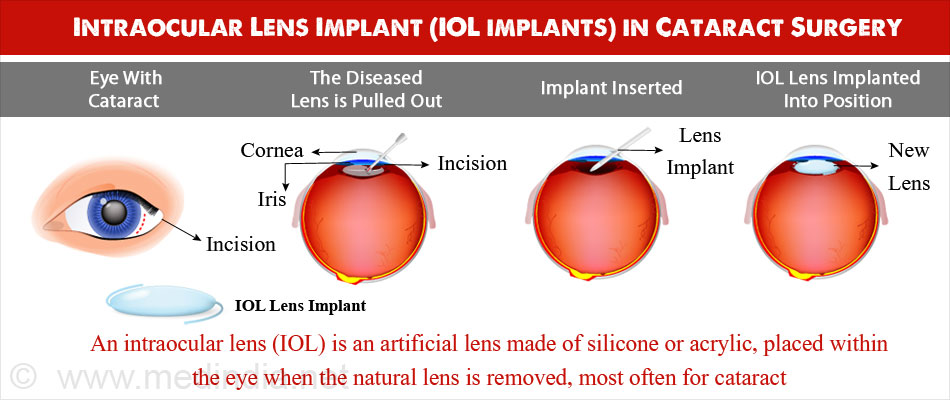 Intraocular Lens Implants Iol Types Procedure Recovery Complications