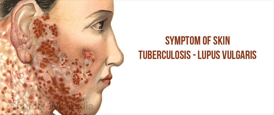 Skin Tuberculosis Causes Symptoms Diagnosis Treatment Prevention