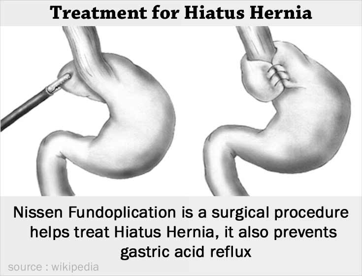 hiatus-hernia-types-causes-symptoms-complications-diagnosis