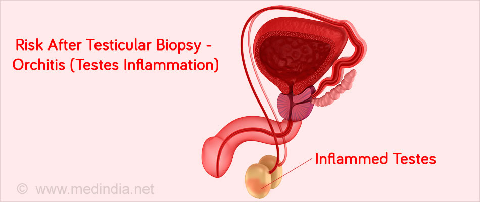 Testicular Biopsy Types Procedure Precautions Risks And Results