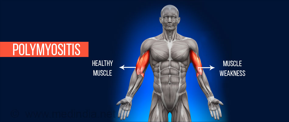 Polymyositis Types Causes Symptoms Complications Diagnosis Treatment