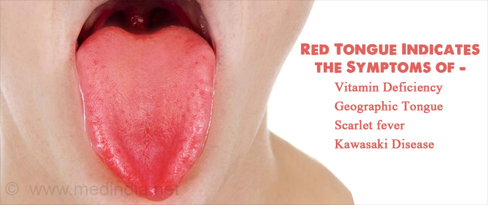 learn-what-your-tongue-says-your-general-health