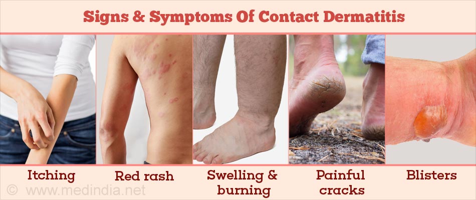 Contact Dermatitis Causes Symptoms Treatment And Prevention 