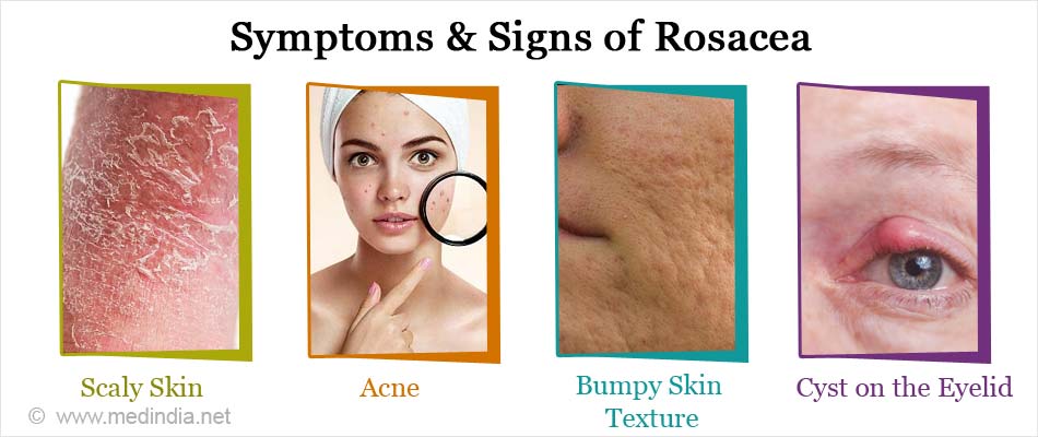 Rosacea Causes Types Symptoms Diagnosis Treatment And Prevention 