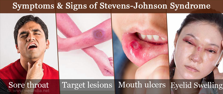 Stevens Johnson Syndrome Causes Symptoms Diagnosis Treatment