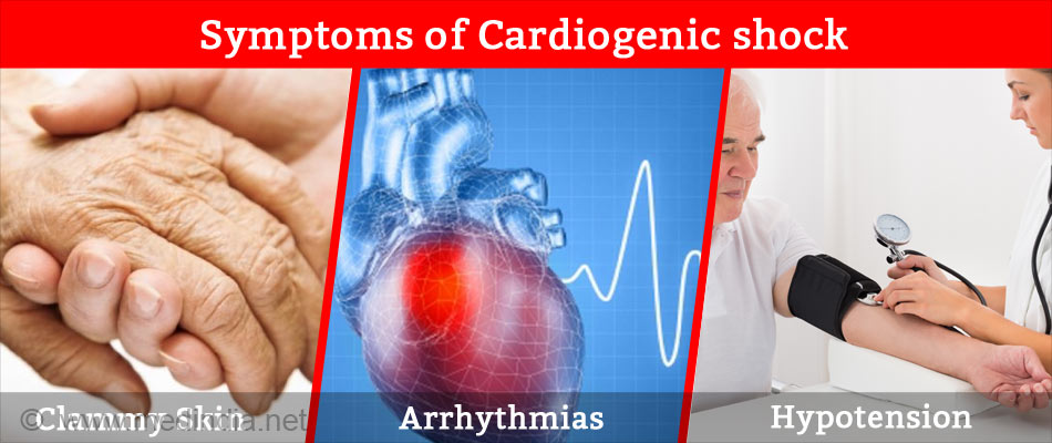 cardiogenic-shock-causes-symptoms-diagnosis-treatment-prevention