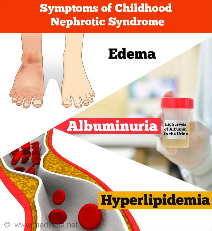 Nephrotic Syndrome Diagnosis Criteria