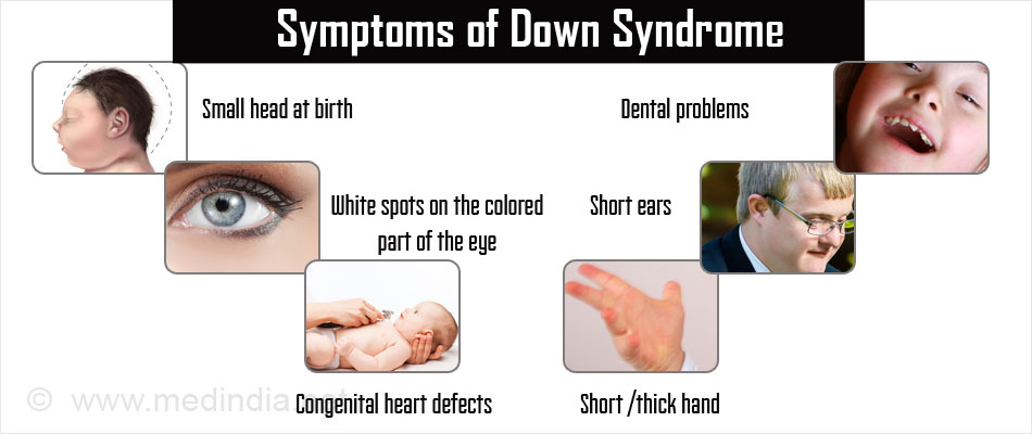 Demens Hos Voksne Med Downs Syndrom Diagnostiske Utfordringer