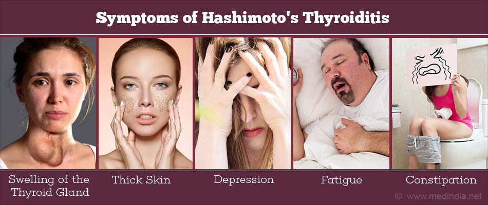 Early Symptoms Of Hashimotos Disease Recognize Disease 