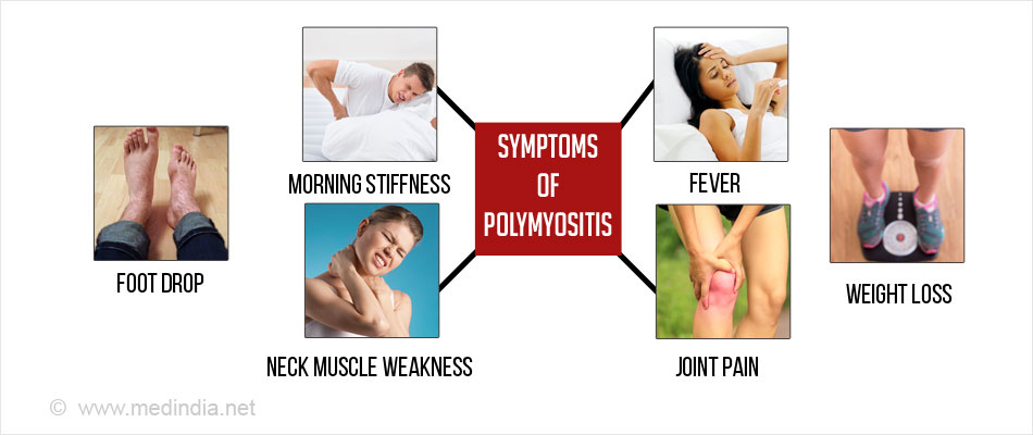 polymyositis-types-causes-symptoms-complications-diagnosis-treatment