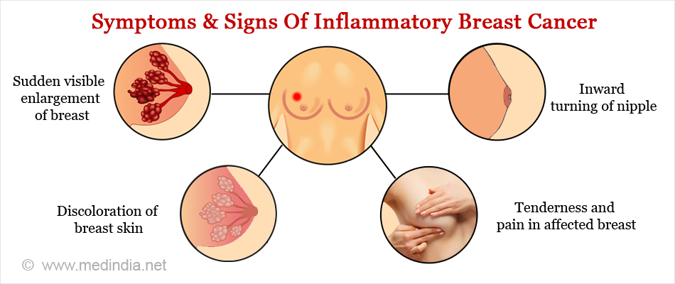 Inflammatory Breast Cancer Causes Symptoms Diagnosis Treatment And Prognosis