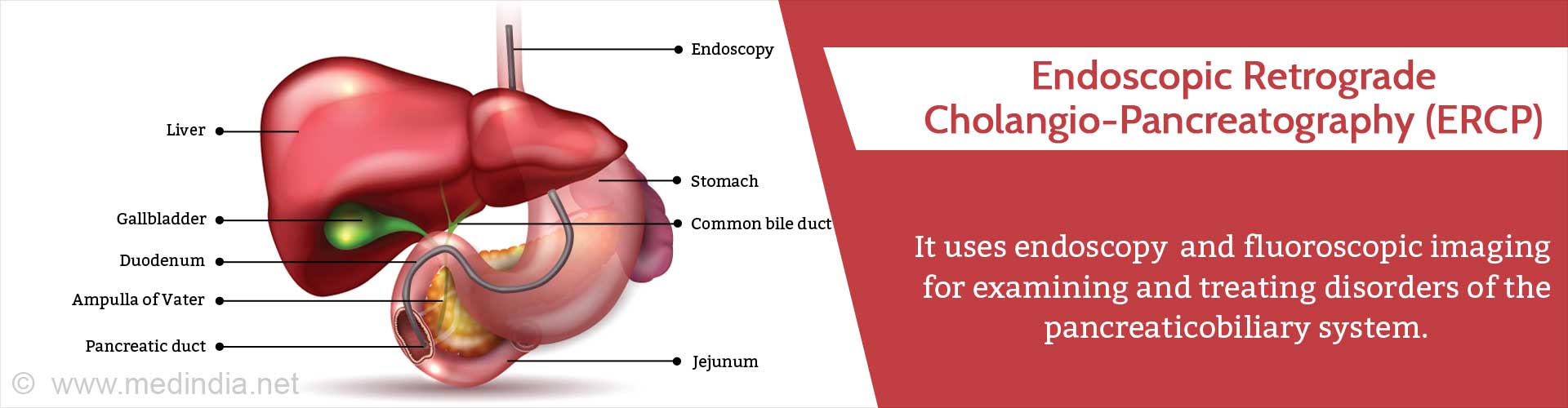 Endoscopic Retrograde Cholangio-Pancreatography (ERCP)