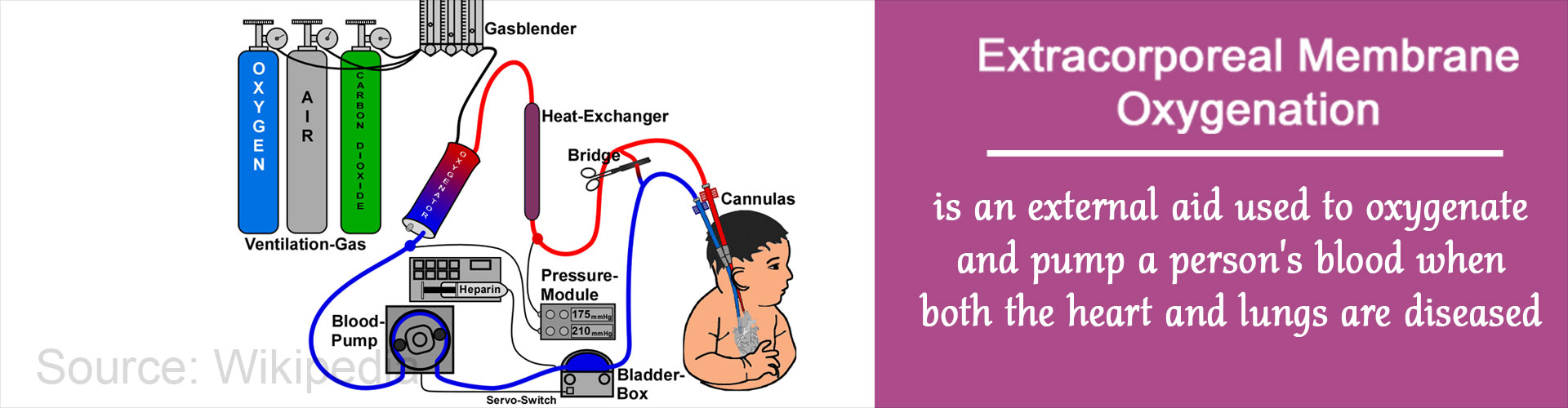 Ecmo Extracorporeal Membrane Oxygenation