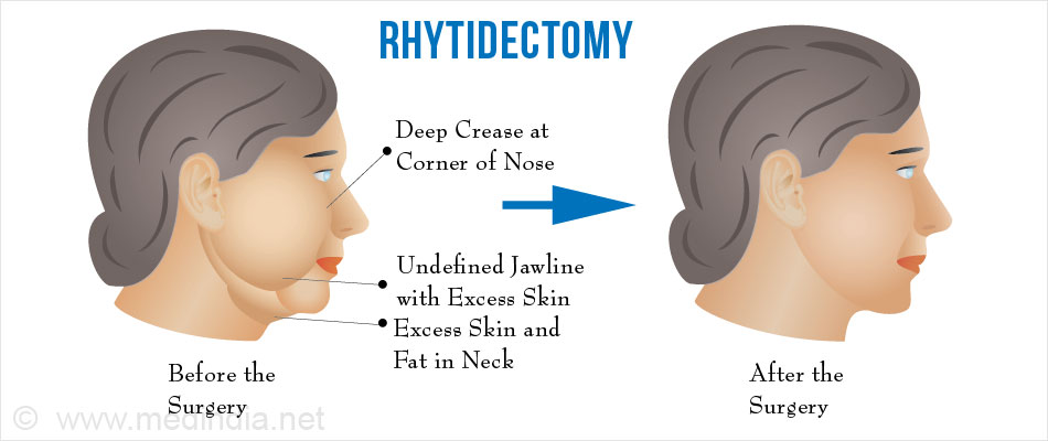 Facelift Rhytidectomy Surgical Procedures 5680