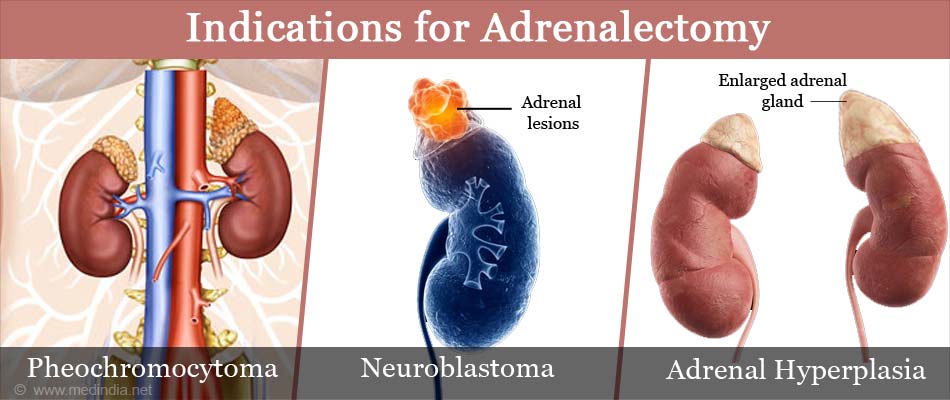 Adrenalectomy Complications And Prognosis