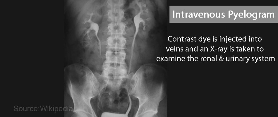 Percutaneous Nephrolithotomy Pcnl