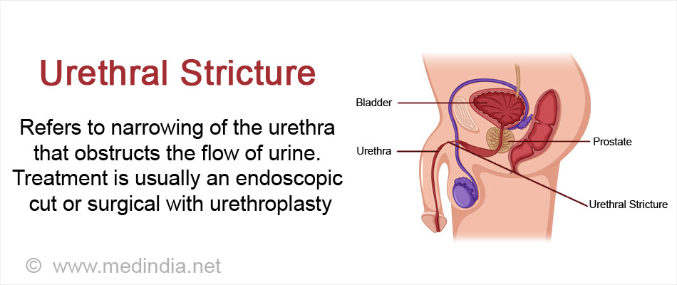 Urethral Stricture Causes Symptoms Complications Diagnosis Treatment