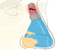 Nose Bleed   Epistaxis - Causes - Symptom - Treatment - Prevention