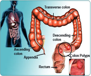 Colon Polyps Causes Symptoms Diagnosis Treatment Prevention Complications