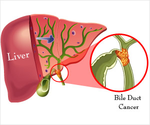 Bile Duct Cancer Cholangiocarcinoma Causes Risk Factors Symptoms