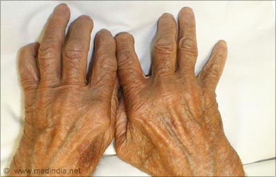 Castor Oil for Pain: Rheumatoid Arthritis