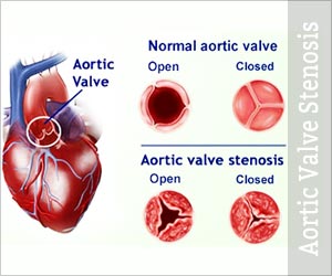 Aortic-Valve-Stenosis.jpg