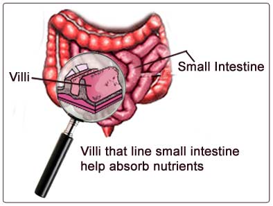 celiac disease biopsy