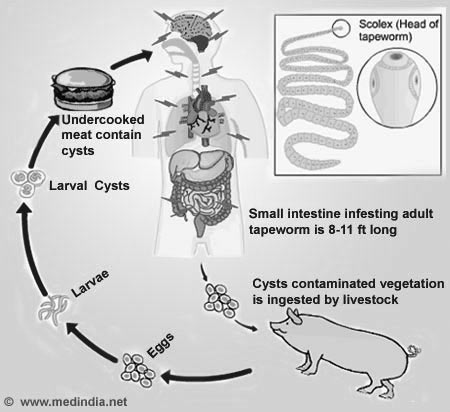 Neurocysticercosis - Print