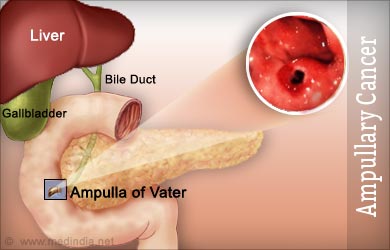 Ampullary Cancer | Cancer of the Ampulla of Vater