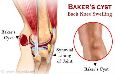 cyst baker bakers rupture swelling knee calf fluid causes pain treatment case symptoms patientinfo patients medindia