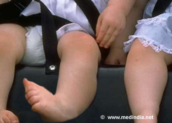 Causes Of Clubfoot