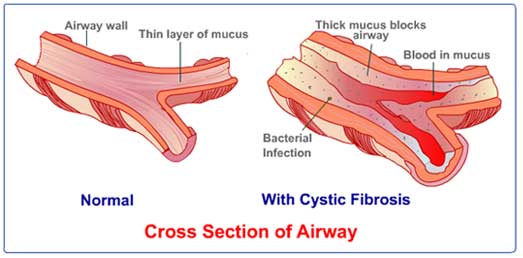 Airway Blocks