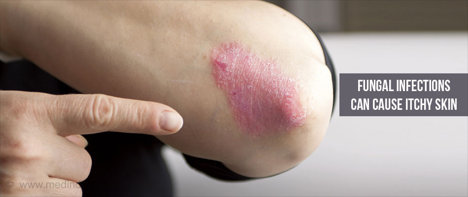 does itraconazole cause itchy skin