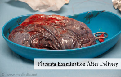 postpartum hemorrhage placenta examination